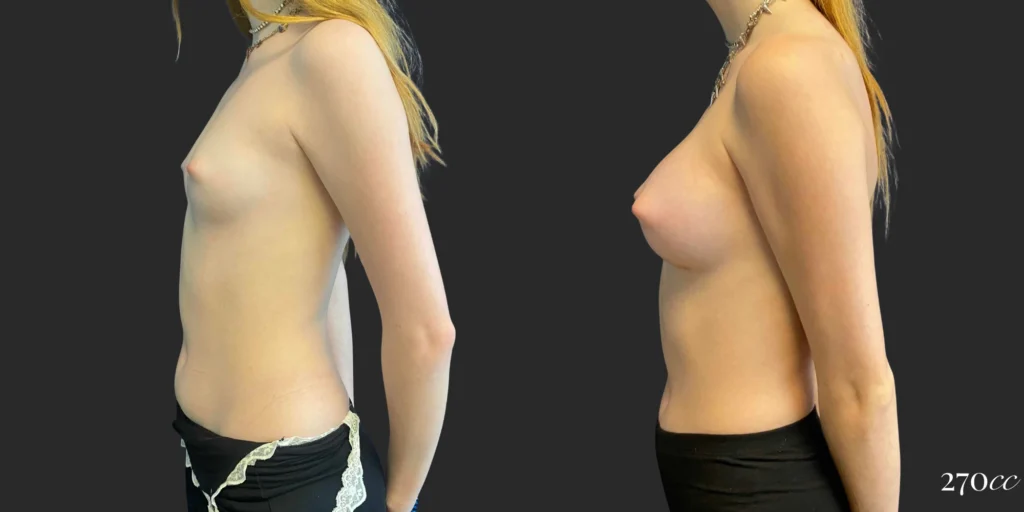 Breast Augmentation #107, before and after photo, view 3