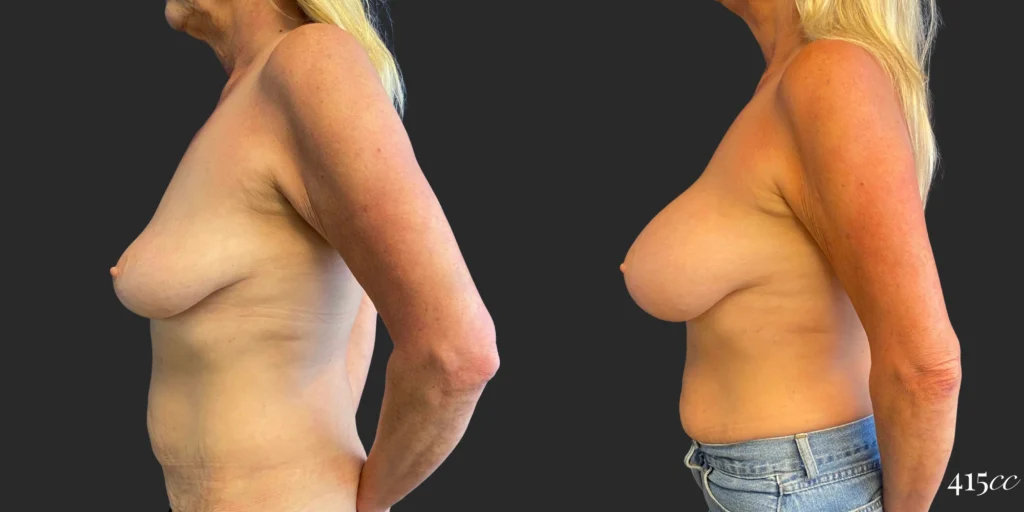 Breast Augmentation #109, before and after photo, view 3