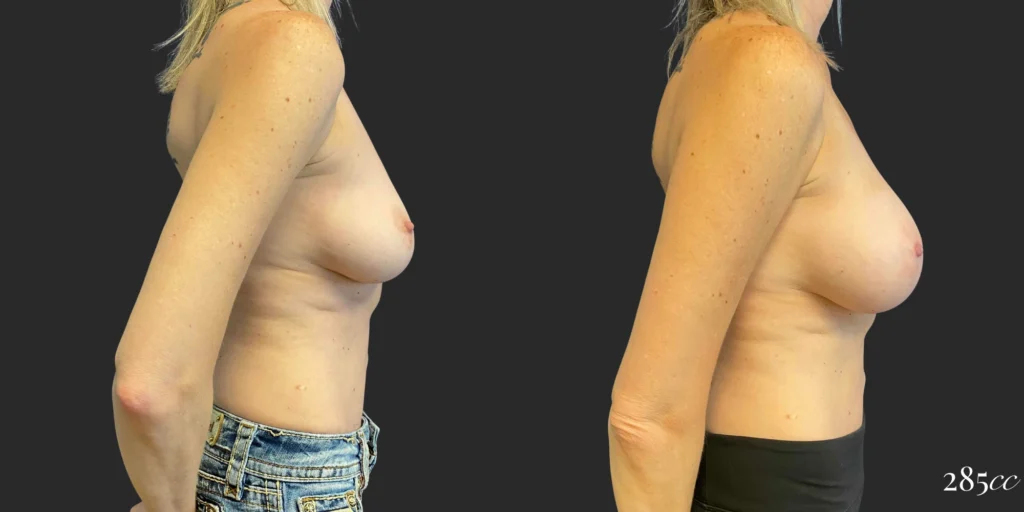 Breast Augmentation #110, before and after photo, view 3