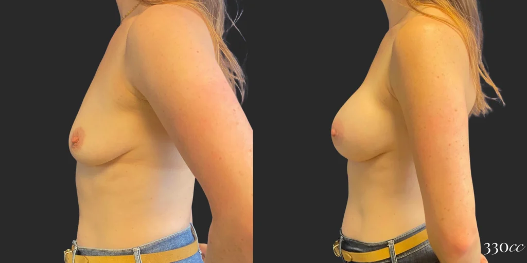 Breast Augmentation #111, before and after photo, view 3