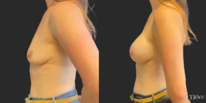 Breast Augmentation #111, before and after photo, view 3