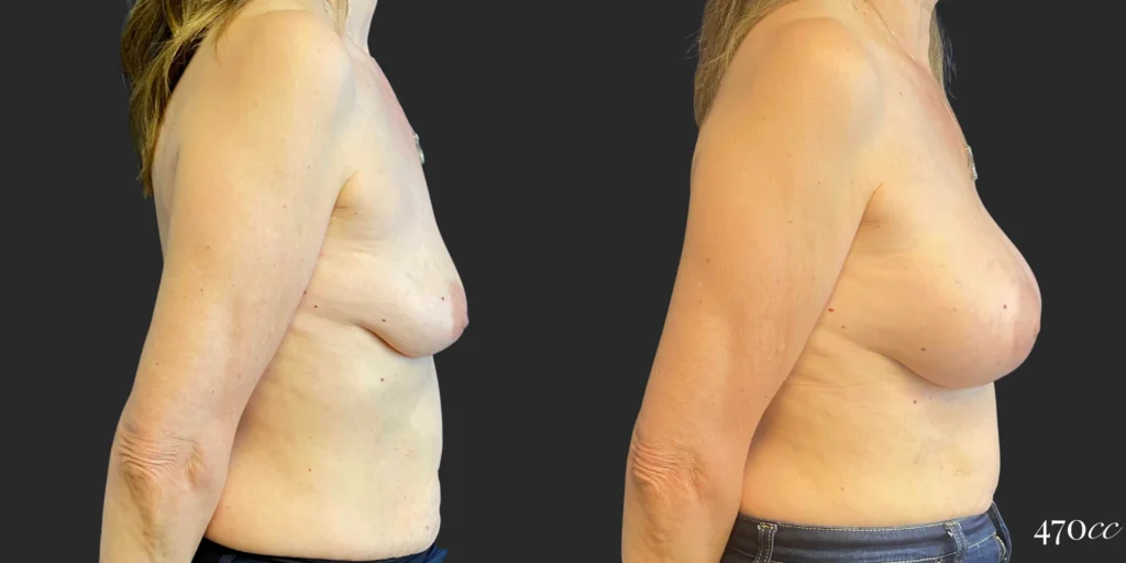 Breast Augmentation #112, before and after photo, view 3