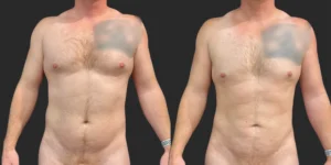 360 Lipo + Chest + Front Brall Roll with Fat Transfer to Buttocks #043, before and after photo