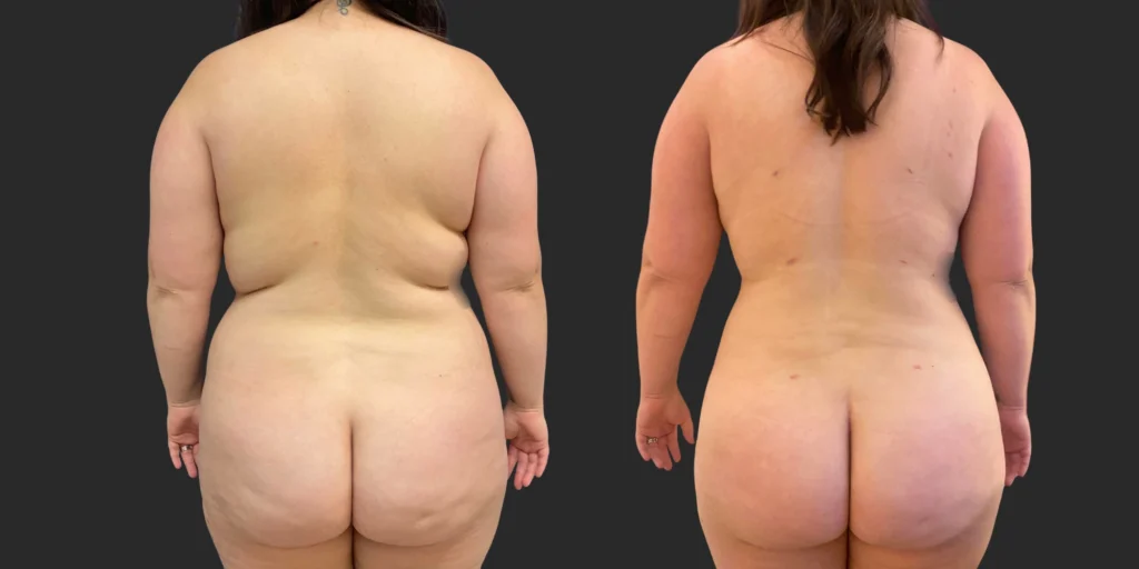 360 Lipo #042, before and after photo, view 4