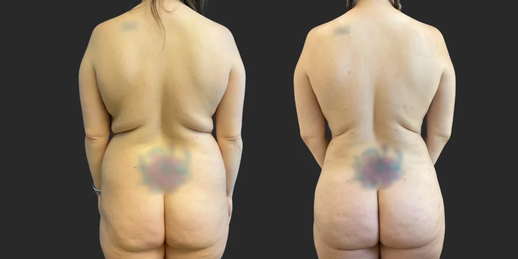 360 Lipo with Fat Transfer to Buttocks + Breasts #041, before and after photo, view 4