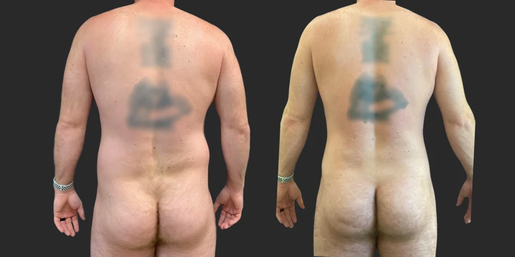 360 Lipo + Chest + Front Brall Roll with Fat Transfer to Buttocks #043, before and after photo, view 4