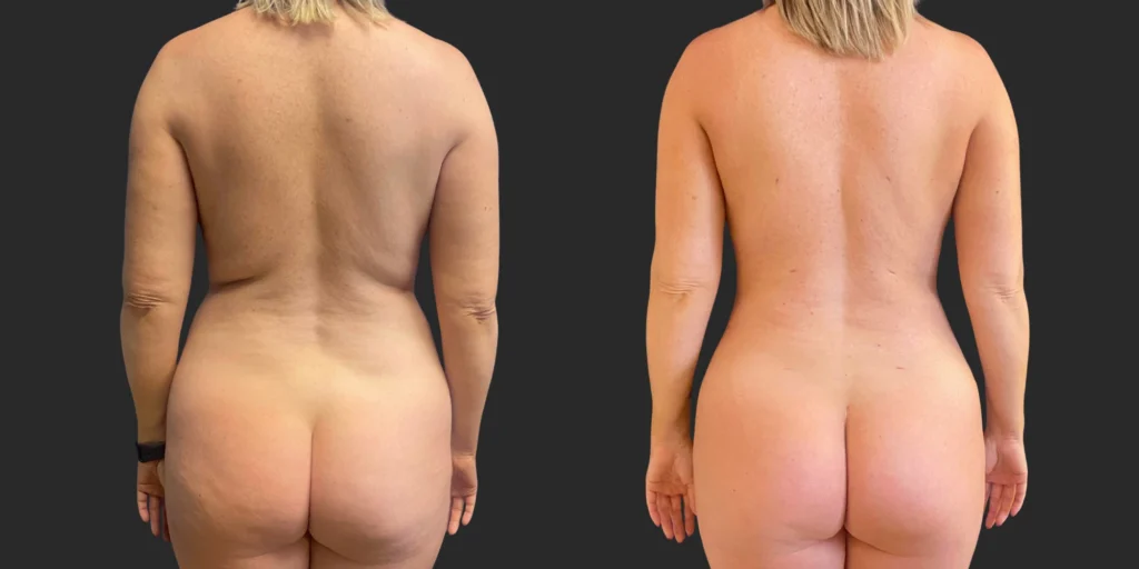 360 Lipo #044, before and after photo, view 4