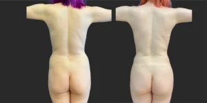 360 Lipo with Fat Transfer to Buttocks + Breasts #045, before and after photo, view 4